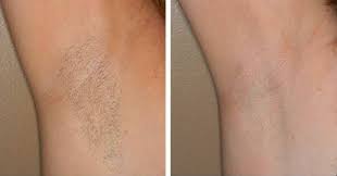 Ingrown hairs in this area, however, may be located in places too sensitive to exfoliate. Botox Barrie Martin S Rejuvenation Centre Laser Hair Removal