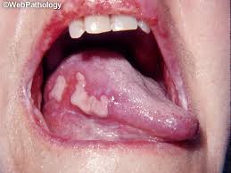 Image result for Pemphigus