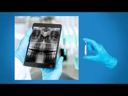 Maybe you would like to learn more about one of these? X Ray Mesial Shift Slob Technique Youtube