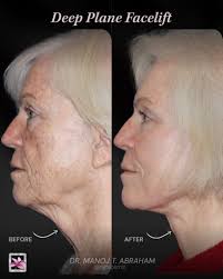 Minimal tension. Maximum transformation. 💫 These before & afters show the  power of the Deep Plane Facelift, a signature procedure by Dr. Manoj T.  Abraham. Unlike traditional techniques, this advanced method lifts