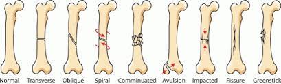 Grab pressure point on hand. How To Break Your Arm Or Leg Quora