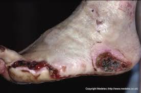 We did not find results for: Diabetic Foot Ulcers Neuropathic Woundsource