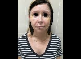 Facial Fat Transfer Sydney