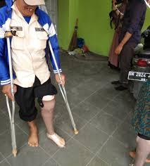 Tasxxx lebih semangat dalam menjalani hidup. Kaki Palsu Pekanbaru Tanjung Pinang Indoorthopro Twitter
