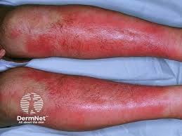 Image result for erythema nodosum