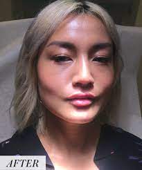 I Got Lip Fillers For The First Time Before And After Photos Allure