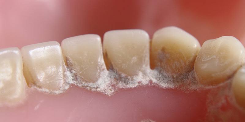Dental Plaque Removal product image