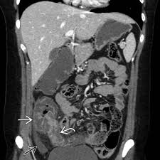 Image result for Neutropenic Colitis