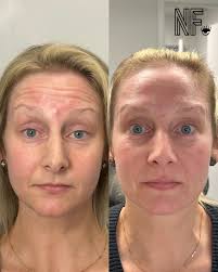 The type of before and afters we love to see. ✨👏🏼 Wrinkle free yet  natural looking.