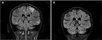 Image result for Microscopic Polyangiitis