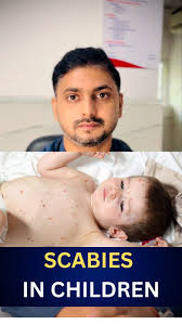 Image result for scabies human children