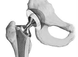 *seniors *elderly, disabled, handicapped *hip replacement recovery, and those suffering from back pain or other injuries. Hip Precautions After Hip Surgery Learn To Prevent Dislocation