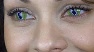 Bonjour, j'aimerai savoir si les lentilles rigides aggravaient le kératocône puisque c'est une maladie. Lentilles De Contact Attention Les Yeux Rts Ch