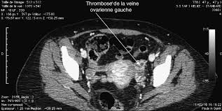 René gräber erläutert symptome, vorbeugung, prophylaxe und die therapie bei einer thrombose aus sicht der naturheilkunde und alternativmedizin. Thrombose De La Veine Ovarienne Coupe Transversale Download Scientific Diagram