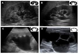 Omics Group Ebooks Renal Ultrasound In Acute Kidney Disease Classifications Of Hydronephrosis Renal Kidney Disease Ultrasound