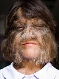 Image result for Hypertrichosis