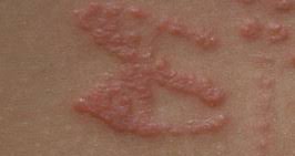 Image result for Contact Dermatitis