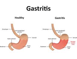 Dalam video ini saya terangkan secara ringkas apakah yang. Gastrik Gerd Dan Anxiety Adaa Inspiration
