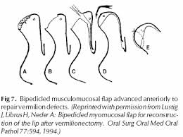 The fujimori gate flap is an innervated flap raised from the nasolabial area for reconstruction of the lower lip. Https Nanopdf Com Download Lip Reconstruction Pdf