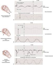Fetal Heart Rate Monitor Interpretation Newborn Nursing Fetal Heart Rate Monitoring Midwifery