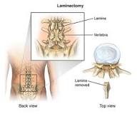 Image result for what is the icd 10 code for laminectomy