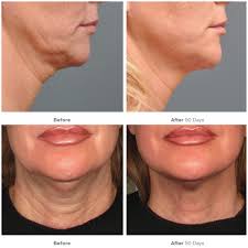 What are the advantages of using ultherapy? Should You Be Afraid Of Ultherapy Review Side Effects And Cost
