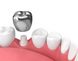 How well you take care of your dental implants, like daily flossing and brushing, seeing a dentist every six months. How Long Do Crowns Last Newmouth