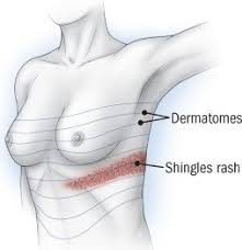 Image result for zoster under breasts