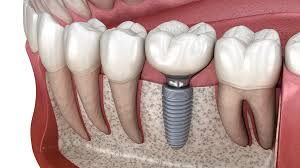 Image result for dental implant