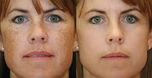 La peau de notre visage est la partie la plus sensible face aux agressions extérieures que ce soit pendant les changements de température, la. Voici Comment Eliminer Les Taches Brunes De Votre Visage En Quelques Minutes Tache Brune Visage Taches Brunes Tache Visage