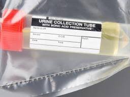 urine test for diabetes types procedures results