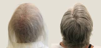 Each follicle goes through these phases independently. General 3 Nhl Med Aesthetics