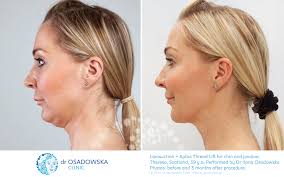 There are different kinds of threads which may be used to lift any part of the face, including the forehead, cheeks, jowls, jawline and neck. Real Photos Liposuction Of Chin And Jawline And Thread Lift Dr Osadowska Clinic Poland