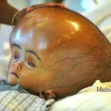 𝐓𝐇𝐀𝐓 𝐂𝐇𝐈𝐋𝐃 𝐖𝐈𝐓𝐇 𝐓𝐇𝐄 𝐁𝐈𝐆 𝐇𝐄𝐀𝐃 𝐈𝐒𝐍'𝐓 𝐂𝐔𝐑𝐒3𝐃 Have you ever seen a child with a very big head and heard people whisper, '𝐍𝐚 𝐬𝐩𝐢𝐫𝐢𝐭𝐮𝐚𝐥 𝐚𝐭𝐭𝐚𝐜𝐤'?" That condition is called 𝐡𝐲𝐝𝐫𝐨𝐜𝐞𝐩𝐡𝐚𝐥𝐮𝐬. It