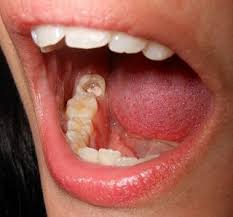 Inilah Obat Alami Sakit Gigi Berlubang Paling Ampuh Gigi