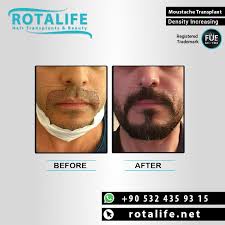 Maybe you would like to learn more about one of these? Beard Transplant In Turkey Hair Transplant Beard Transplant Hair Solutions