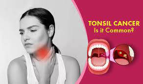 Asbestos linked to throat cancer. Let S Beat Tonsil Cancer Sooner Cancer Healer Center