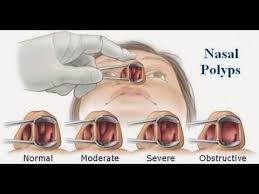 Using a humidifier may help moisten your breathing passages, improve. Http Youtu Be 6wcnctc Onm How To Remove Nasal Polyps Naturally Without Surgery 100 Http Ift Tt 2dqxva2 Allergy Remedies Sinusitis