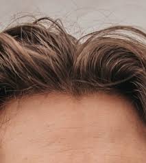 Some children noticeably lose their 'baby hair' before a new head of hair comes in, and for some the two things happen at once, so it's not easy to see the change happening. Bald Spots Overview Causes Treatment Options And More Aedit