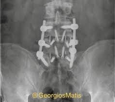A Typical Fbss Patient With Chronicpain Spinalcordstimulation Scs Neuromodulation For Painrelief Neurosurgery Functionalneu Chronische Schmerzen