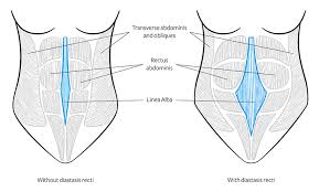 The best way to heal diastasis recti naturally is to not compensate or cheat when doing certain moves at the gym and implementing exercises that focus on healing a diastasis recti. Diastasis Recti Symptoms How Do I Know I Have Diastasis Recti
