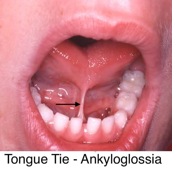 TONGUE TIE SURGERY product image