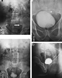 Image result for Genitourinary Tuberculosis