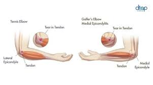 Golfer's elbow, or medial epicondylitis, is when you have irritation on the inside of your elbow. Tennis Elbow Golfer S Elbow Symptoms Treatment Dr Tan Partners