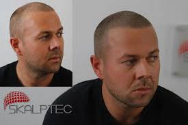 Celebrities with Scalp Micropigmentation