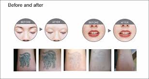 Surgical removal, also called excision tattoo removal, involves cutting off tattooed skin and stitching remaining skin back together. 1064nm 532nm Nd Yag Laser Tattoo Removal Home Use Yag Laser Skin Rejuvenation Buy Tattoo Removal Home Use Laser Tattoo Removal Nd Yag Laser Product On Alibaba Com