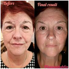 Check out this incredible whole eyes and frown lines result 😲😲