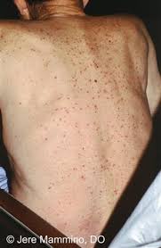 Grover S Disease American Osteopathic College Of Dermatology Aocd