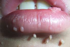 Image result for papillomavirus tongue)