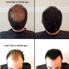 One of the most common signs of balding is a shift in your hairline. Toppik Vs Caboki Hair Solution That Suits You Better Hairfibers Com
